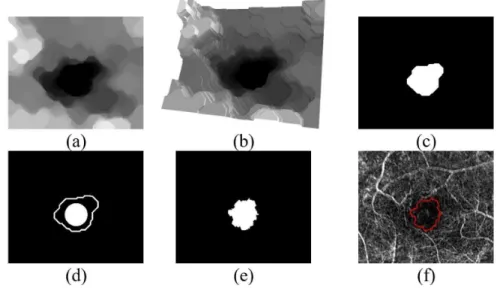 Figure 2. Foveal avascular zone (FAZ) localization and segmentation. (a) Alternating sequential iltering (ASF) image ( n=10); (b) 3D representation  of topographical surface of this image in greyscale as a relief altitude; (c) Region determined from the gl
