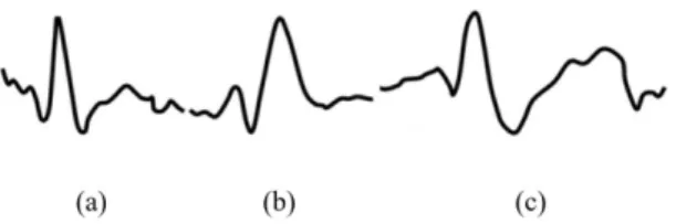 Figure 1.  Most common epileptiform paroxysms in EEG signals. 