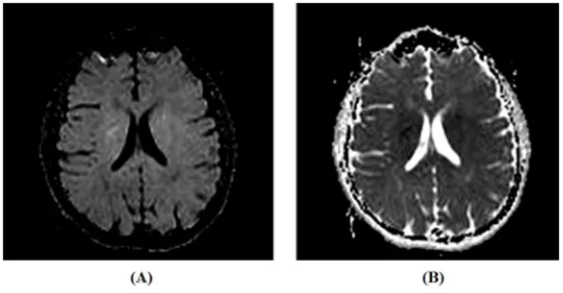 Figure 2. DWI image and ADC map. Examples of DWI image (A) and ADC map (B) of an adult human brain