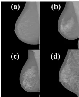 Figure 1. INbreast database: examples of the four categories of breast  density in mediolateral oblique view