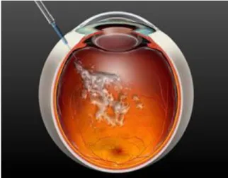 Figura 4 - Injecção intravítrea (retirada de www.oftalmologiaonline.com.br).