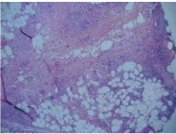 Figura 3: Inflamação septal com extensão do  infiltrado entre os adipócitos,  (5)