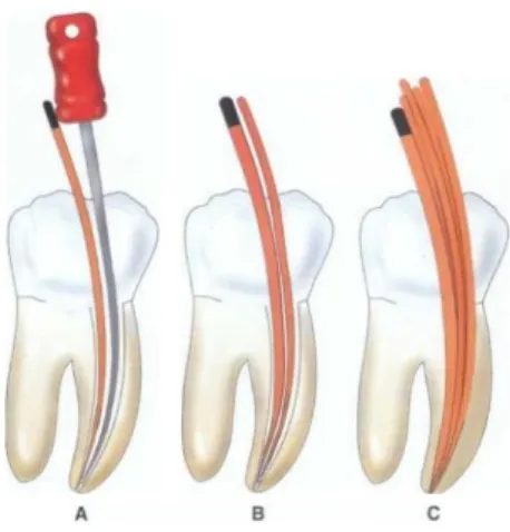 Figura 4: Técnica de condensação lateral (adaptado de Colour Atlas of Endodontics,  2002) 