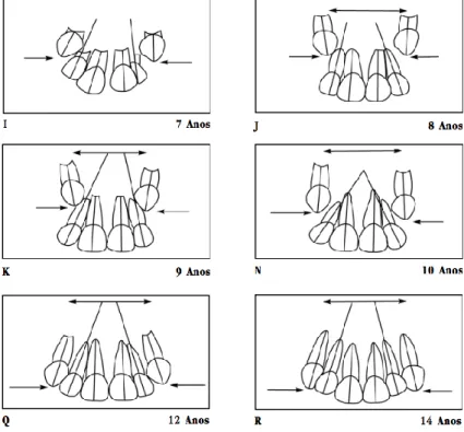Figura 3: Visão Frontal das alterações axiais (normais) que acontecem na erupção dos  incisivos e dos caninos na fase de dentição mista (adaptado de Janson, 1998)