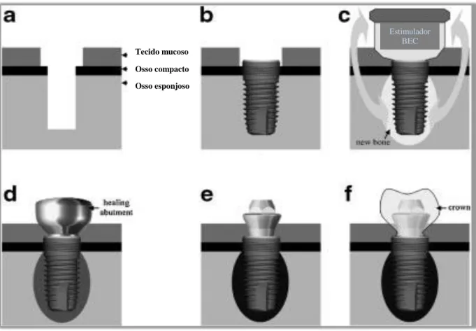 Figura 5 – Procedimento de tratamento para implantes dentários com dispositivo BEC  Fonte : Adaptado de Song et al, 2009; 
