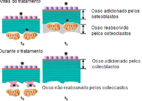 Figura 3 - Modelo de como o pamidronato afeta o número de trabéculas. 