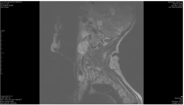 Figura 4 – RMN cervical (11/04/2014), corte sagital, evidenciando a massa vascularizada