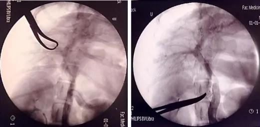 Figura 7. Portovenografia mesentérica intraoperatória antes (esquerda) e depois da atenuação (direita)  do shunt esplenocava de um cão com 1 ano, macho e Jack Russel (fonte: original, 2019)