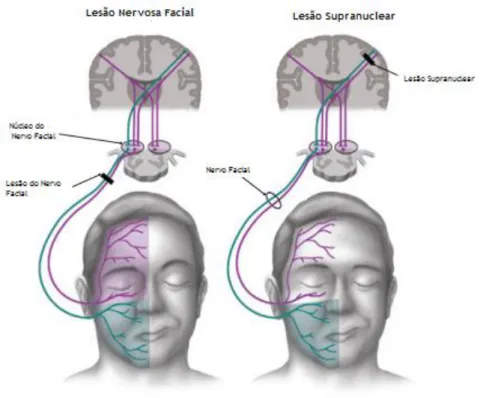 Figura 8- Lesão facial nuclear e lesão facial supranuclear [Adaptado e traduzido de (4)]