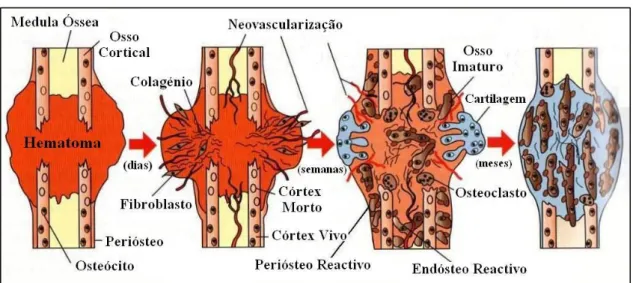 Figura 3 – Esquema da cicatrização óssea secundária (Adaptado de Weisbrode, 2007) 