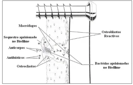 Figura 7 – Microambiente numa Osteomielite (Adaptado de Piermattei, Flo &amp; DeCamp,  2006) 