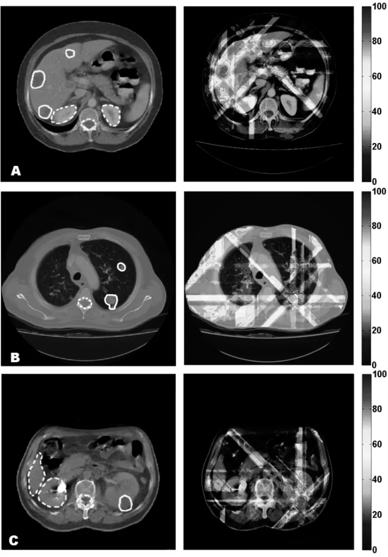 Figure 4 – Computed tomography images used in the simulations. The detached regions with full lines represent the tumor location and the detached regions with dashed lines represent the critical tissues locations