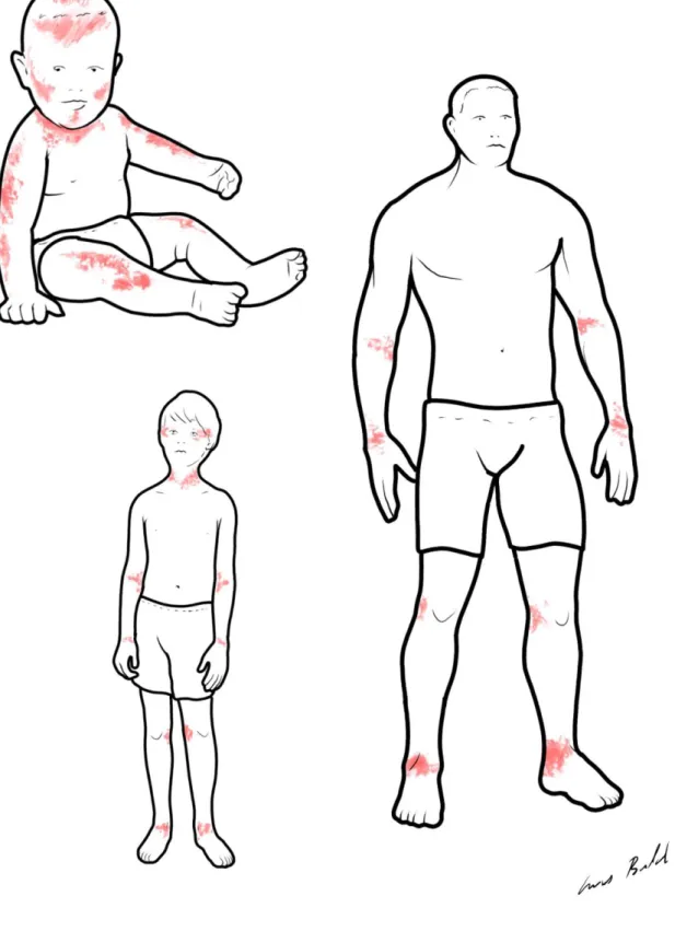 Figura 5 – Representação da alteração dos locais típicos de lesão na DAH consoante a idade