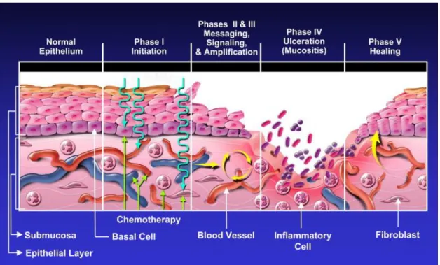 Figura  5  –  Biopatologia  da  mucosite:  o  processo  das  cinco  fases  (Sonis,  2004  cit  in  Sieracki, et al., 2009)