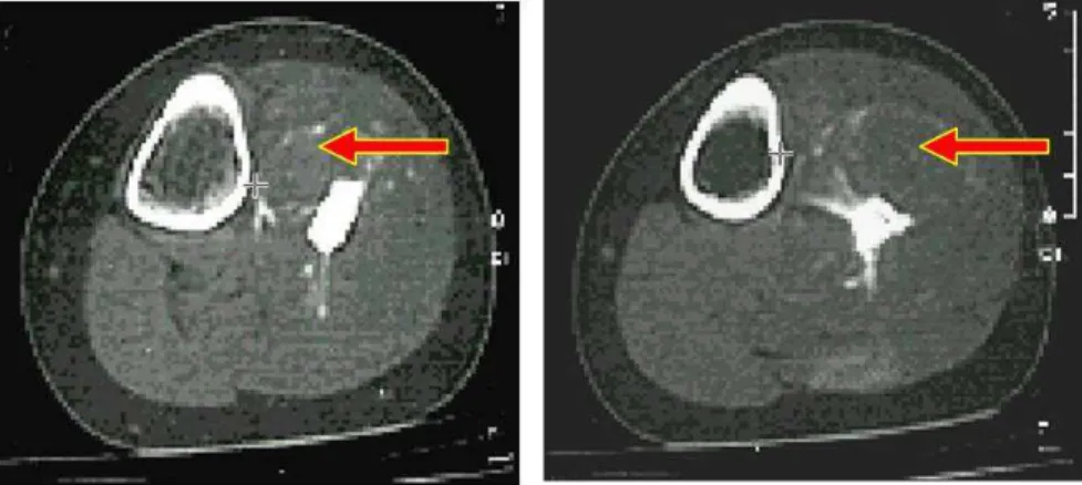 Figura 1: Ilustração de duas imagens de TC em cortes axiais de um tumor ósseo localizado na fíbula  (indicado pelas setas)