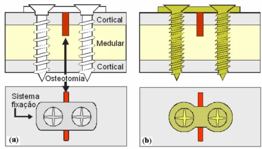 Figura 1: Ilustração esquemática da osteotomia transversal fixada com placa e parafusos (a)  PLDLA e (b) controle a base de titânio