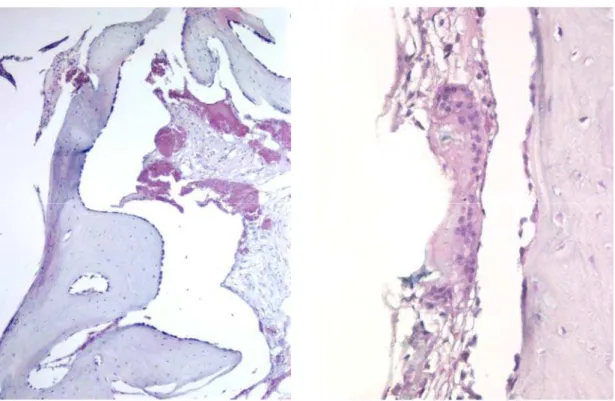 Figura 4: 2 meses – A) Polímero – Região em contato com o polímero, presença de grande quantidade de  osteoblastos e neoformação óssea ; B) Região em contato com o titânio, apresentando célula gigante de corpo 