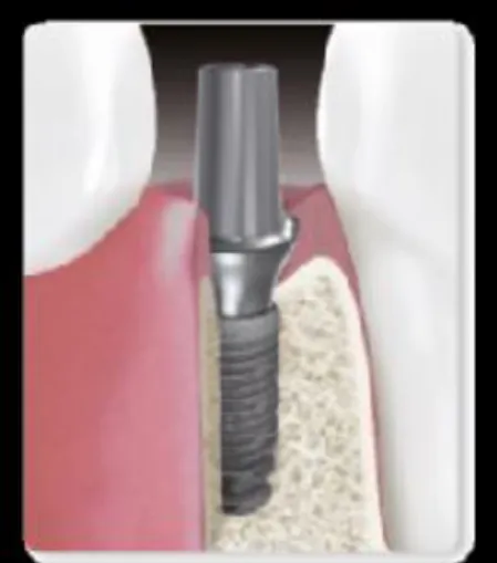 Figura  4  -  Implantes  Platform  Switching  com  conexão  interna  do  tipo  Cone  Morse