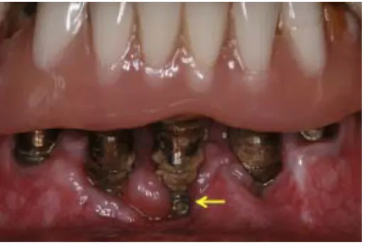 Figura 4 Placa dentária sobre as superfícies  implantares (Romanos et al., 2014). 