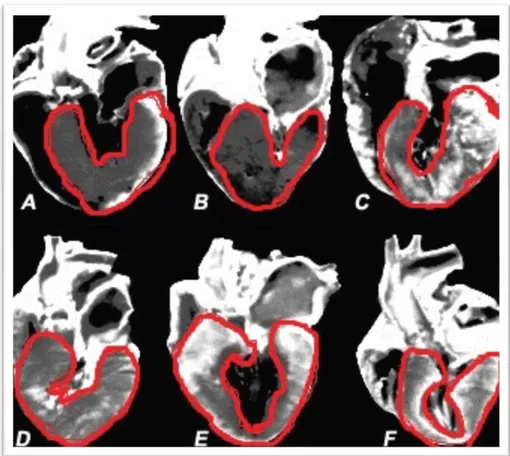 Figura 1  – Padrão de distribuição de hipertrofia cardíaca, em corações de gatos com CMH  (amostras de cortes longitudinais, correspondente a ecografia bidimensional, em eixo longo  com vista paraesternal direita) [adaptado de Fox 2003]