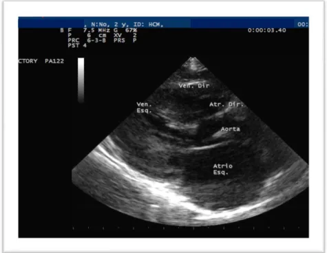 Figura 6 – Ecocardiografia na vista paraesternal direita no eixo longo das 5 câmaras,  compatível com dilatação do AE imagem de “Smoke” (cortesia do HVR) 