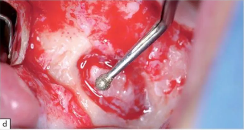 Figura 4. Ostectomia na concretização da janela lateral de acesso para o levantamento  do seio maxilar