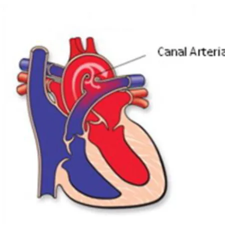 Figura 2: Canal arterial persistente. Adaptado de American Heart Association (25) 