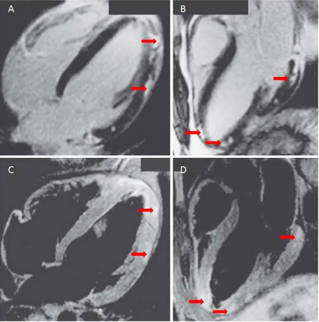 Figura 3 – Imagem de Ressonância Magnética com Contraste do coração de um doente de 24 anos  com miocardite aguda