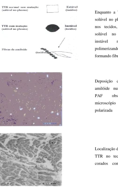 Figura 2. Esquema Representativo da Amilóide (TTR Mutada) 