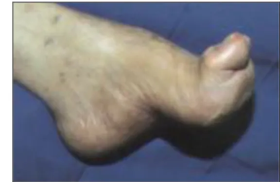 Figura  3  –  À  esquerda,  pé  neuropático  com  proeminência  ao  nível  da  cabeça  dos  metatarsos  (Edmonds  &amp;  Foster,  2006)