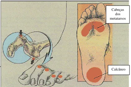 Figura 7 – Locais mais frequentes de ulceração no pé diabético. Esta ocorre com frequência na  parte  dorsal  dos  dedos  e  na  região  plantar  ao  nível  das  cabeças  dos  metatarsos  e  do  calcâneo  (Armstrong &amp; Lavery, 1998)