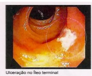 Figura 5 – Ulceração em íleo em  colonoscopia de paciente com DII  Ulceração em íleo terminal em paciente com doença de Crohn  Fonte: Arquivo do autor  