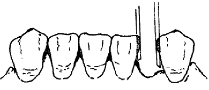 Figura 2: Preparação das superfícies dentárias dos dentes anteriores (Rudd et al., 1999)