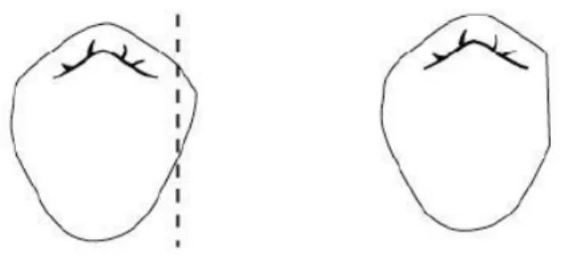 Figura  5:  Preparação  do  plano-guia;  (A)  Dente  com  um  contorno  normal;  (B)  Dente  com um plano-guia preparado na face proximal (Loney, 2011) 