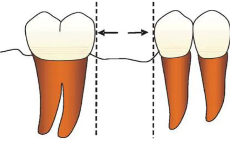 Figura  6:  Esquema  representativo  das  superfícies  proximais  com  áreas  retentivas  e  ângulo cervical “morto” (Zavanelli et al., 2004)