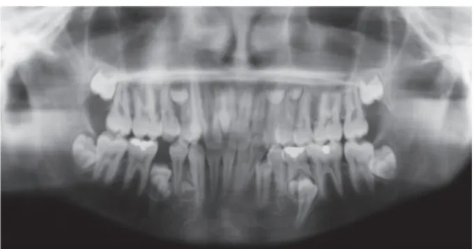 Figura 1 – Radiografia Panorâmica apresentando  múltiplos dentes supranumerários. 