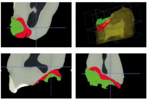 Figura  3:  Análise  da  Micro  CT.  Em  vermelho,  limite  de  remoção  de  tecido cariado com brocas carbide em baixa rotação e, em verde, com  brocas de polímero