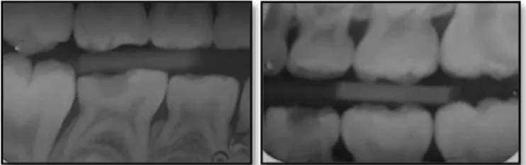 Figura  5:  Exemplos  de  imagens  radiográficas  de  lesões profundas de casos do estudo