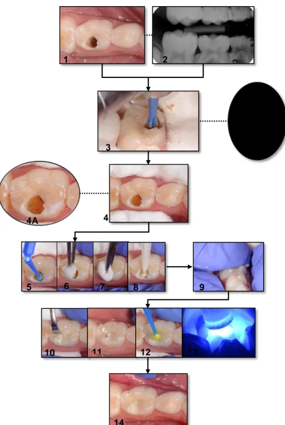 Figura 6: Remoção de dentina cariada da parede pulpar, protocolo O. A fotografia inicial (1) e a  radiografia interproximal (2) mostram presença de lesão profunda classe I