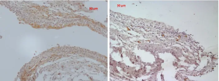 Figura 4. Activação das ERK 1 e 2 no urotélio macroscopicamente normal de doentes com CCTB