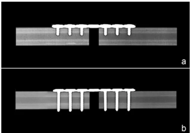 Figure 1. Seven-hole 3.5 mm locking reconstruction plate designed  with locking rings inserted into the plate holes (a)