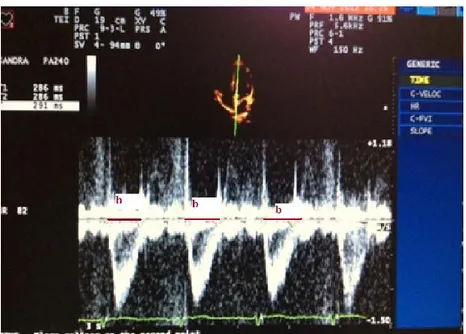 Figura  4  -  Medidas  do  tempo  de  ejeção  ao  doppler  pulsado  transvalvar mitral, em ciclos cardíacos separados 