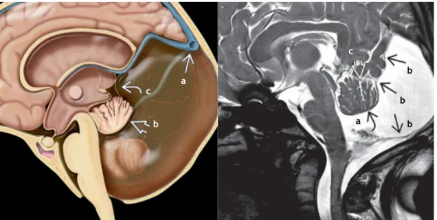 Figura 6. Malformação de Dandy-Walker - (Esquerda) Aumento da fossa posterior, confluência dos seios  elevada  (a),  rotação  superior  do  vérmis  cerebelar  hipoplásico  (b),  4º  ventrículo  dilatado  com  paredes  finas  (c)  e  hidrocéfalo