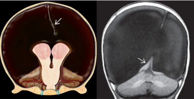 Figura  10.  Hidranencefalia  - (Esquerda)  Os  hemisférios  cerebrais  estão  praticamente  ausentes,  mas  o  tálamo,  tronco  cerebral  e  cerebelo  estão  intactos