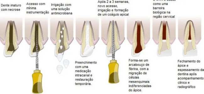 Figura  1  –  Representação  esquemática  do  procedimento  das  etapas  clínicas  da  terapia para revascularização pulpar (5) 