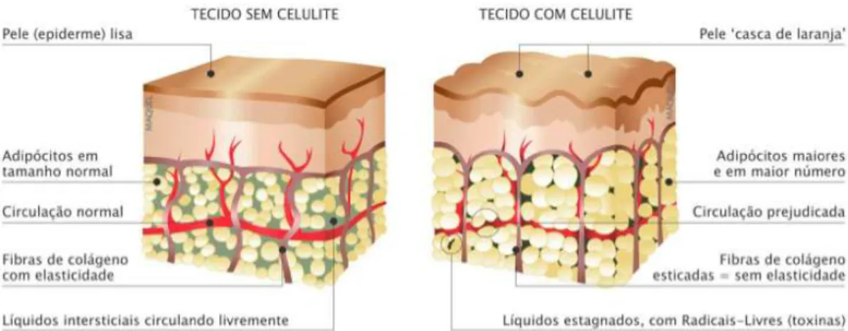 Figura 7 - Fisiopatologia da celulite ( adaptado de http://vejario.abril.com.br/blog/fabiano-serfaty/celulite-o- http://vejario.abril.com.br/blog/fabiano-serfaty/celulite-o-que-e-quais-sao-as-causas-e-como-tratar/).