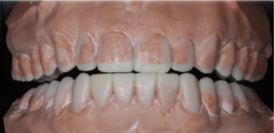 Figura  5:  Enceramento  de  diagnóstico  reconstruindo  com  cera  a  anatomia  dos  dentes  desgastados (caso clínico de autoria própria)