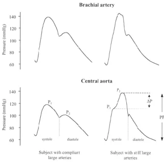 Fig.  5  Representação  esquemática  da  amplificação  da  pressão  de  pulso  (PP)  em  artérias  centrais  complacentes e artérias periféricas rígidas  (25) .