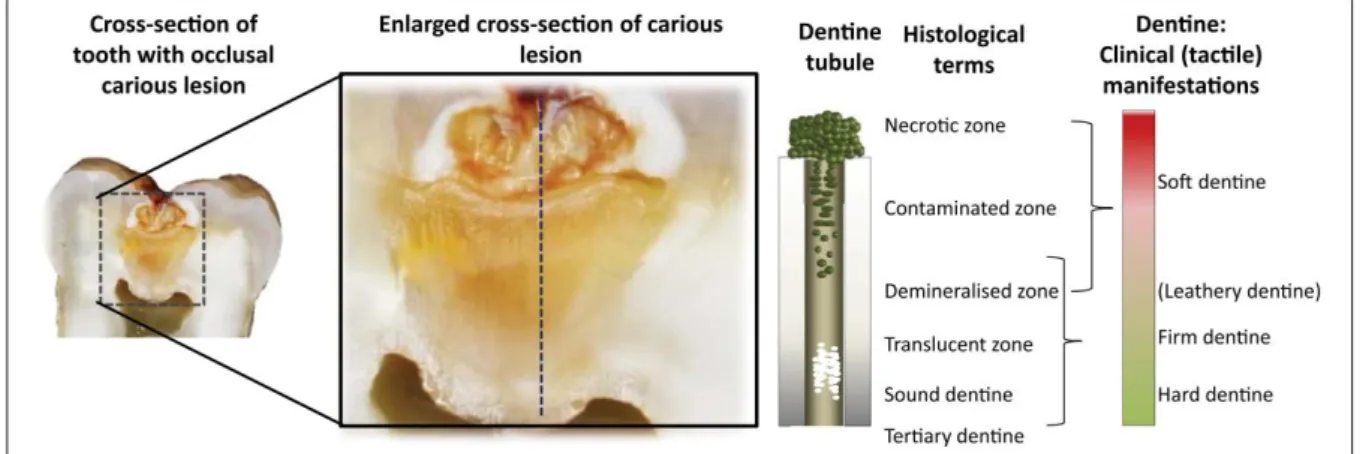 Figura  1.  Diferentes  consistências  da  dentina  na  doença  cárie  e  sua  correlação  com  o  grau  de  contaminação