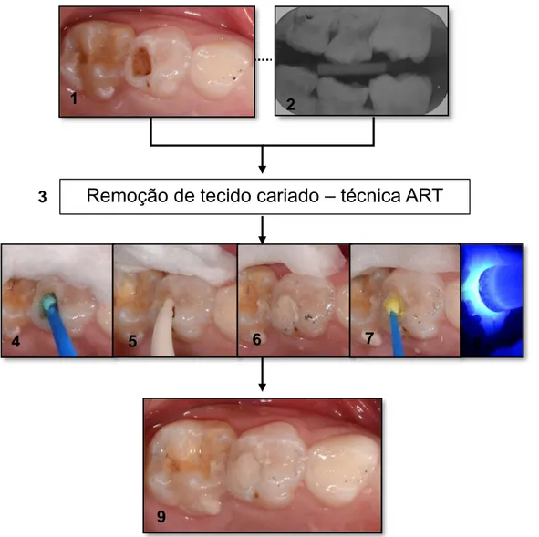 Figura 3- ART e restauração com cimento de ionômero de vidro de alta viscosidade, protocolo CIV- CIV-AV